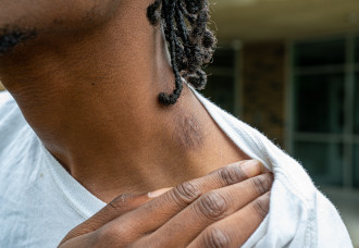 Maliek Hargrave pulls down his shirt collar to expose a scar left by a bullet wound.